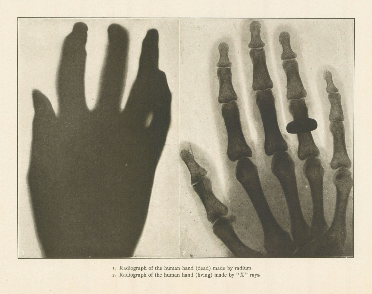 Radium & X-ray radiographs of the human hand 1907 old antique print picture