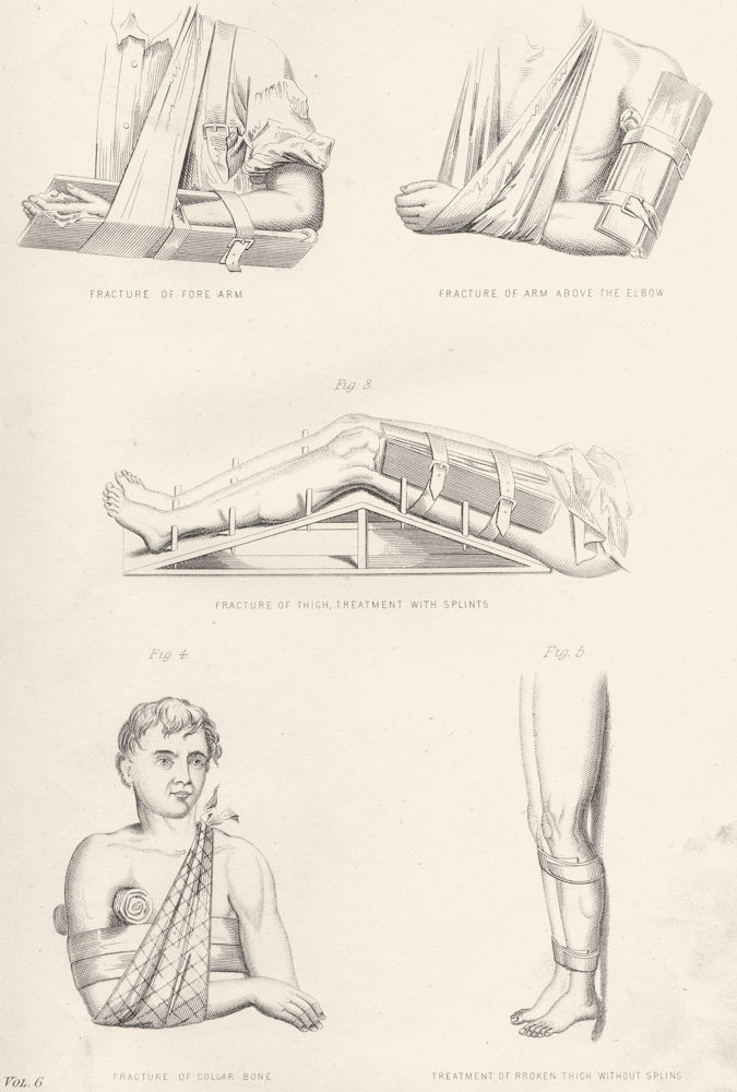 Associate Product MEDICAL. Fractures; Fore Arm; above Elbow; thigh; Splints; Collar bone 1880