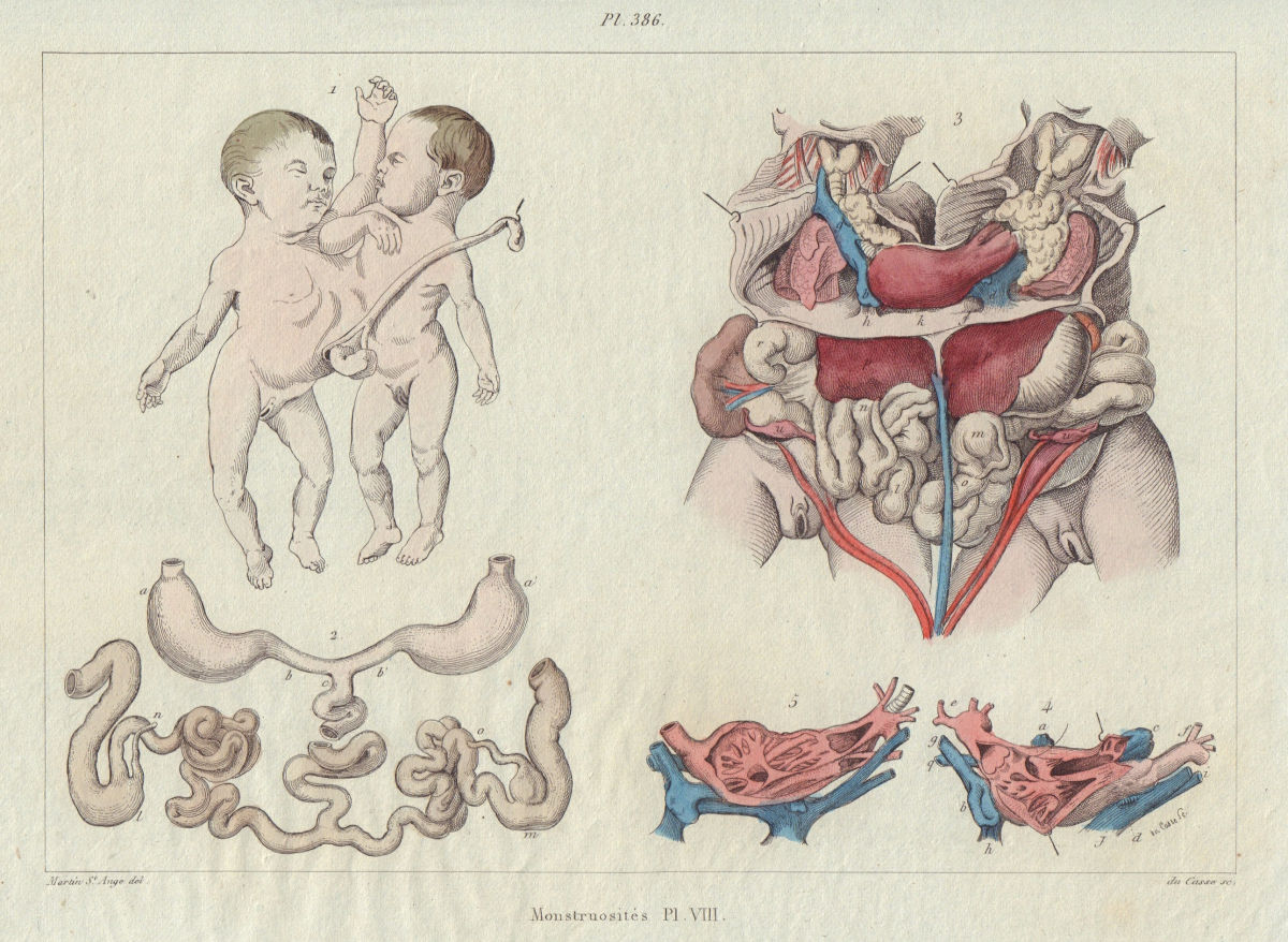 MUTATIONS. "Monstruosités" Pl. VII. Conjoined twins 1833 old antique print