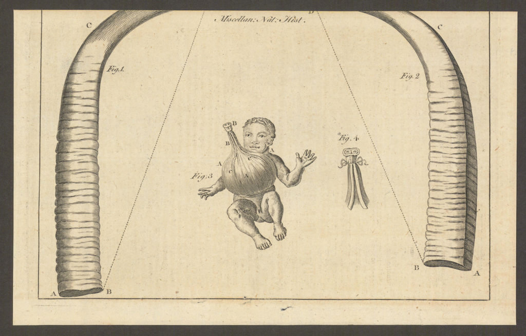 Horns, in Hans Sloane's collection. Infant with omphalos or navel rupture 1769