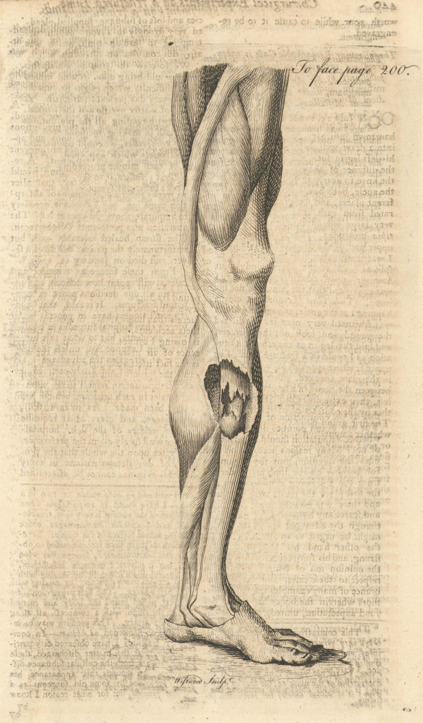 A Man's Leg, fractured in an extraordinary manner. Gentleman's Magazine 1769