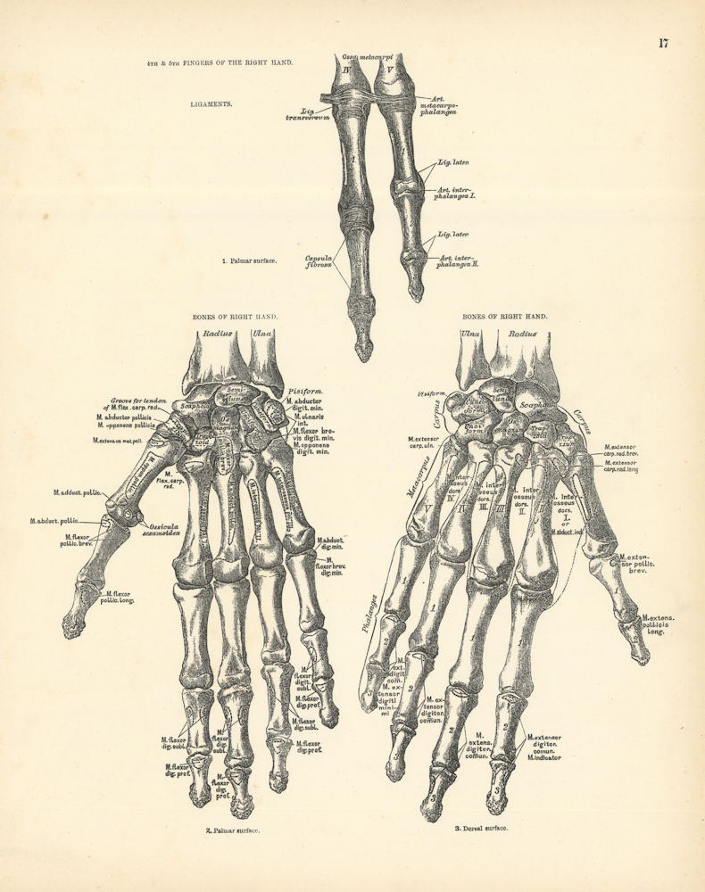 Associate Product Anatomy. 4th & 5th Fingers, Bones of Right Hand 1880 old antique print picture