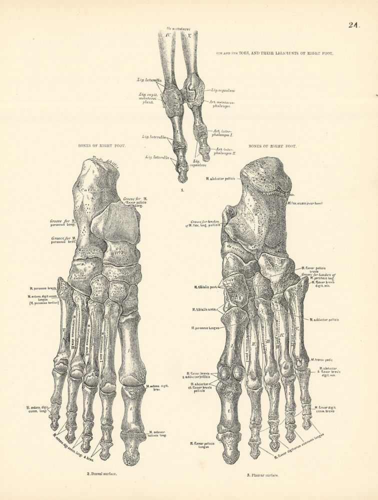 Anatomy. Right Foot Bones, 4th & 5th Toes, Ligaments 1880 old antique print