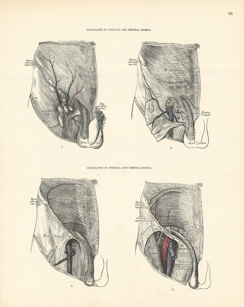 Associate Product Anatomy. Inguinal & Femoral Hernia Topography 1880 old antique print picture